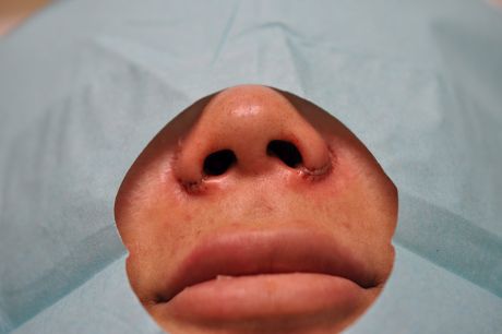 Alarplasty Before & After Photos