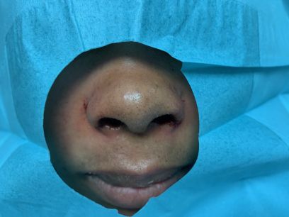 Alarplasty Before & After Photos