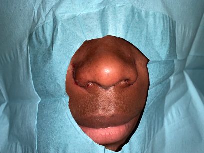 Alarplasty Before & After Photos