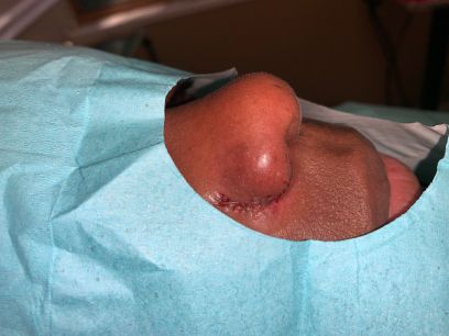 Alarplasty Before & After Photos