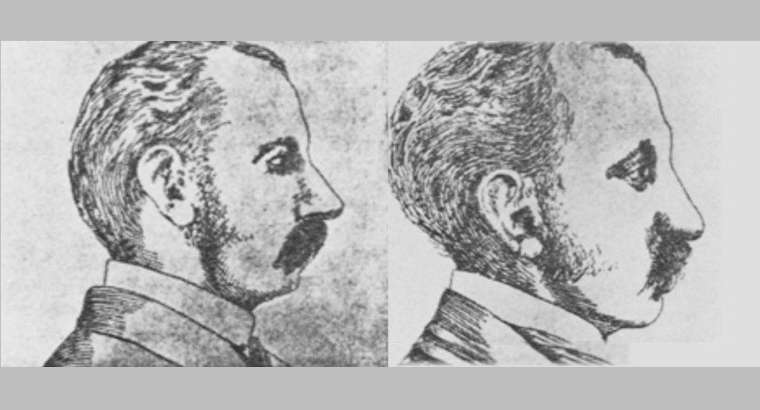The History of Alarplasty Nose Surgery
