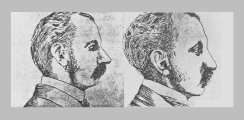 The History of Alarplasty Nose Surgery