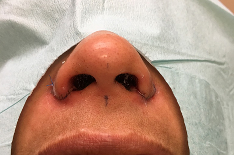 Alarplasty Before & After Photos