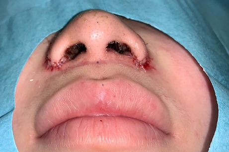 Alarplasty Before & After Photos