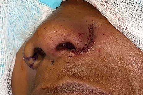 Alarplasty Before & After Photos