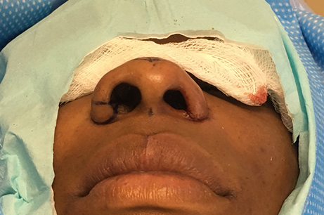 Alarplasty Before & After Photos