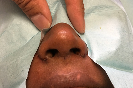 Alarplasty Before & After Photos