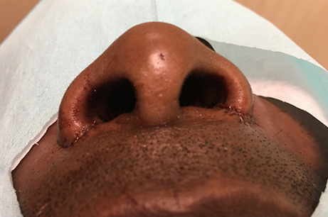 Alarplasty Before & After Photos