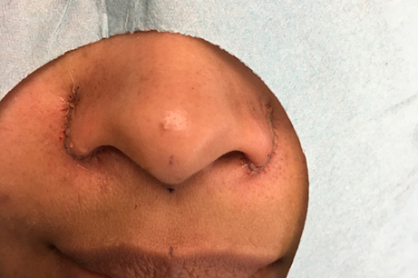 Alarplasty Before & After Photos