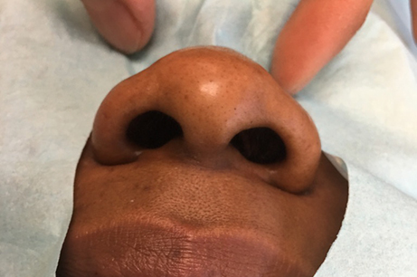 Alarplasty Before & After Photos