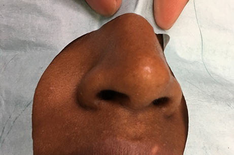 Alarplasty Before & After Photos