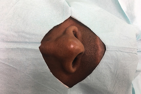 Alarplasty Before & After Photos