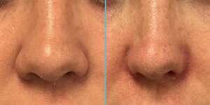 Alarplasty Surgery Home
