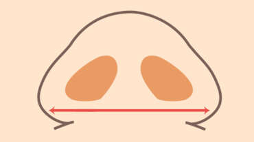 6 Things to Think About Before Alarplasty