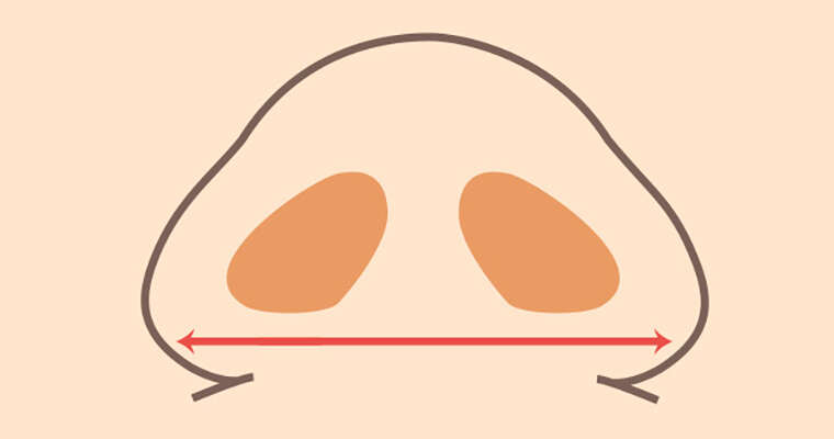 6 Things to Think About Before Alarplasty 1 6 Things to Think About Before Alarplasty