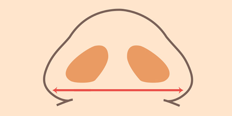 6 Things to Think About Before Alarplasty