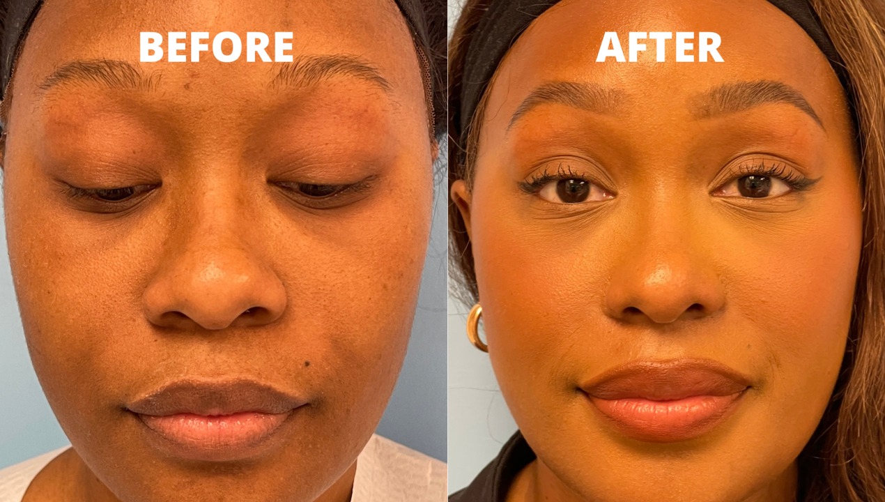 Alarplasty and Tip-Plasty